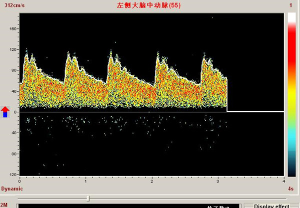 經(jīng)顱多普勒PW模式下單窗口檢測頻譜 經(jīng)顱多普勒PW模式下單窗口檢測頻譜