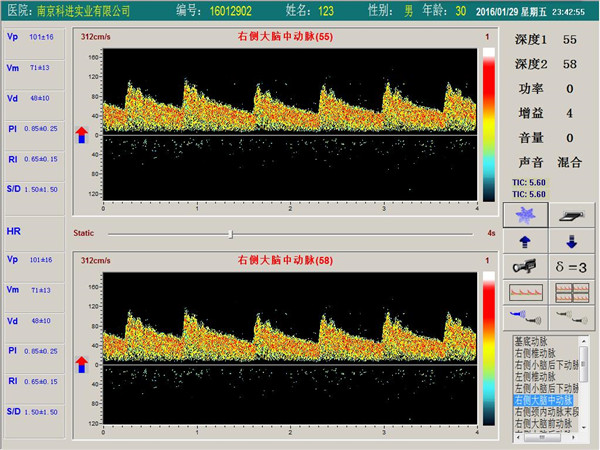 經(jīng)顱多普勒單通道,雙深度界面 經(jīng)顱多普勒單通道,雙深度界面