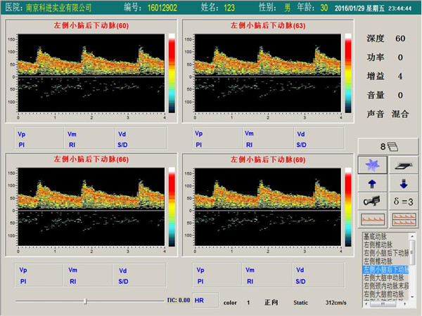 經(jīng)顱多普勒單通道,四深度界面 經(jīng)顱多普勒單通道,四深度界面