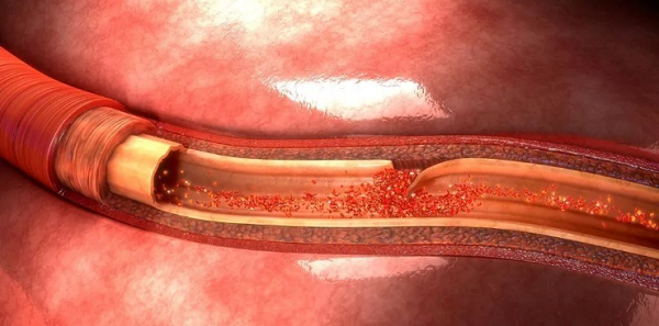 頸動脈夾層是中青年腦卒中受檢者重要誘因