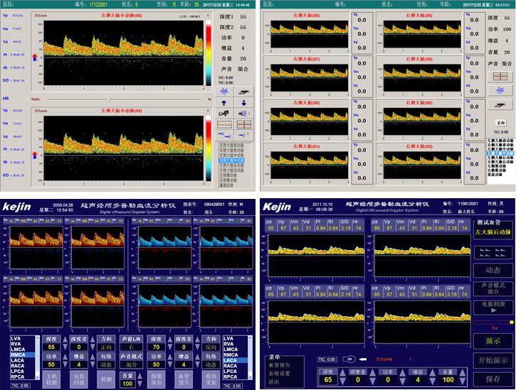 TCD血管定位技術(shù)實(shí)現(xiàn)自動搜索血管信號 TCD血管定位技術(shù)實(shí)現(xiàn)自動搜索血管信號