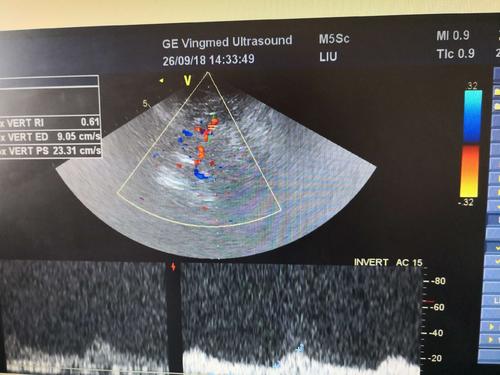 經顱彩色編碼雙功能超聲TCCD成像模式 經顱彩色編碼雙功能超聲TCCD成像模式