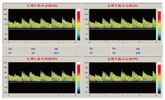 經顱多普勒 經顱多普勒